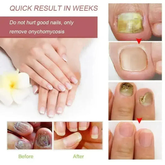 Nail Fungus Treatment Serum